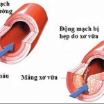 Xơ vữa động mạch và những điều cần biết về căn bệnh này