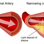 Bệnh rối loạn lipid máu ở người gầy