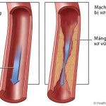 Chỉ số căn bệnh máu nhiễm mỡ bao nhiêu là cao?