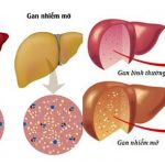 Bệnh lý men gan cao nên ăn gì thì tốt nhất?