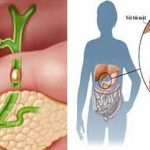 Thể trạng các mẹ và bệnh lý sỏi mật
