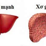 Căn bệnh xơ gan là gì? Cách hỗ trợ điều trị xơ gan